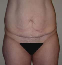 Abdominoplasty