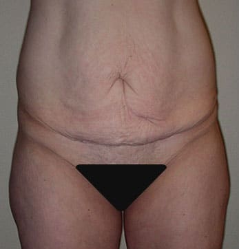 Abdominoplasty