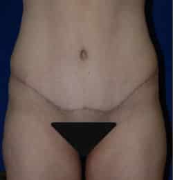 Abdominoplasty