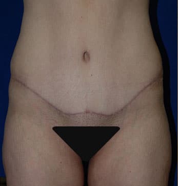 Abdominoplasty