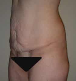 Abdominoplasty