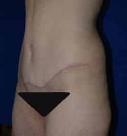 Abdominoplasty