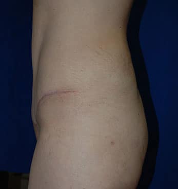 Abdominoplasty