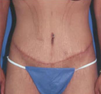 mini tummy tuck