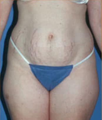 Abdominoplasty