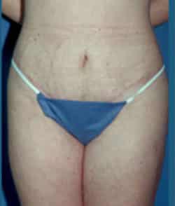 Abdominoplasty