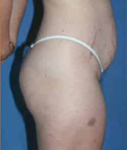 Abdominoplasty