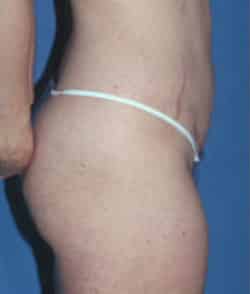 Abdominoplasty