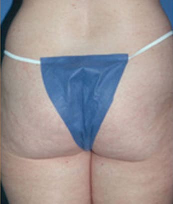 Abdominoplasty