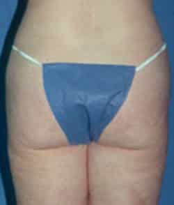 Abdominoplasty