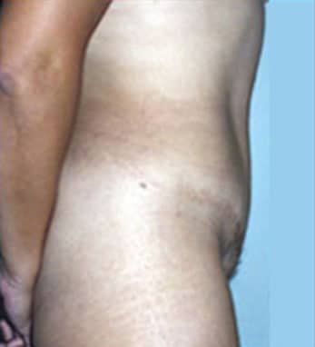 Abdominoplasty