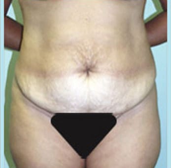 Abdominoplasty