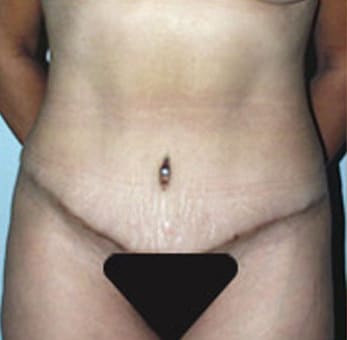 Abdominoplasty