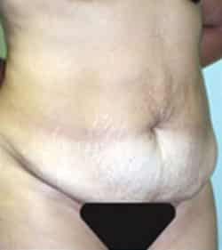 Abdominoplasty