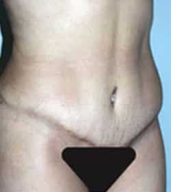 Abdominoplasty