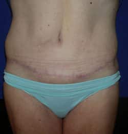 Abdominoplasty