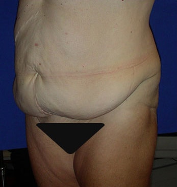 Abdominoplasty