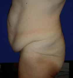 Abdominoplasty