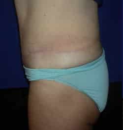 Abdominoplasty