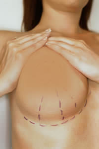 What You Should Know About Gummy Bear Breast Implants - Bayside