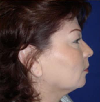 Blepharoplasty