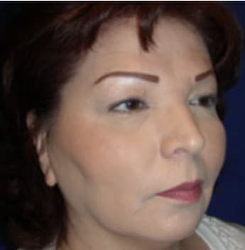 Blepharoplasty