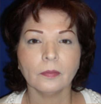 Blepharoplasty