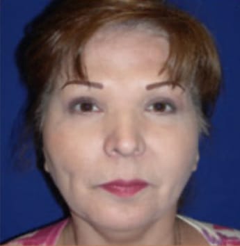 Blepharoplasty