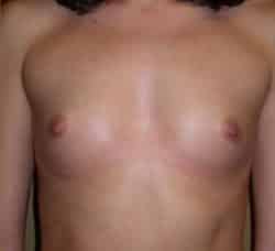 Breast Augmentation