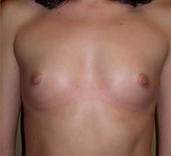 Breast Augmentation