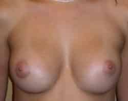 Breast Augmentation