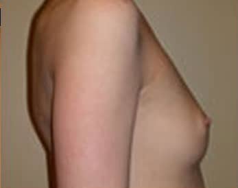 Breast Augmentation