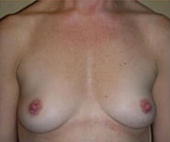 Breast Augmentation