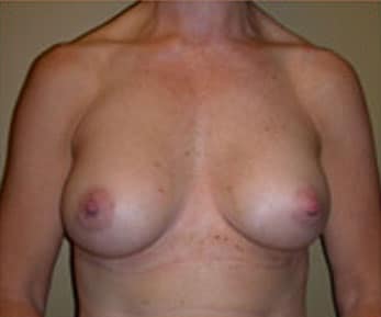 Breast Augmentation