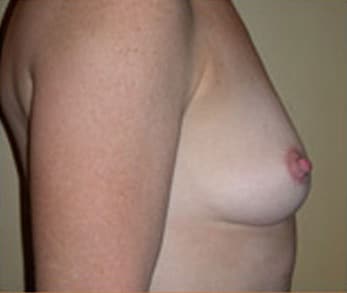 Breast Augmentation