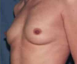 Breast Augmentation