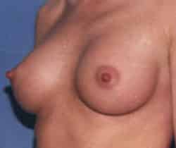 Breast Augmentation