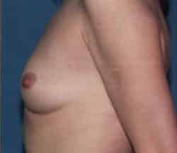 Breast Augmentation