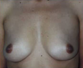 Breast Augmentation