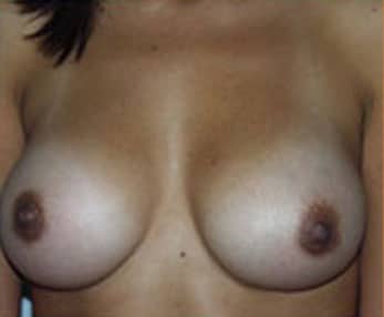 Breast Augmentation