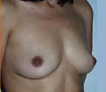 Breast Augmentation