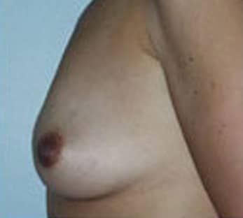 Breast Augmentation