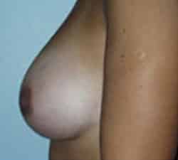 Breast Augmentation