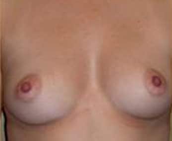 Breast Augmentation