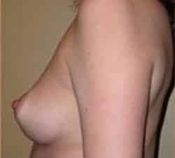 Breast Augmentation