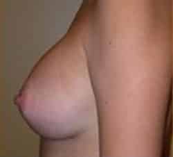 Breast Augmentation