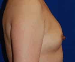 Breast Augmentation