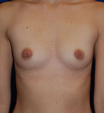 Breast Augmentation