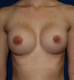 Breast Augmentation