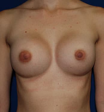 Breast Augmentation